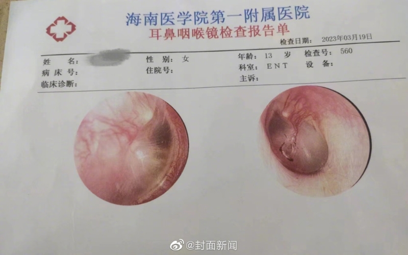 海南醫學院第一附屬醫院開具的耳鼻咽喉鏡檢查報告單。 網圖