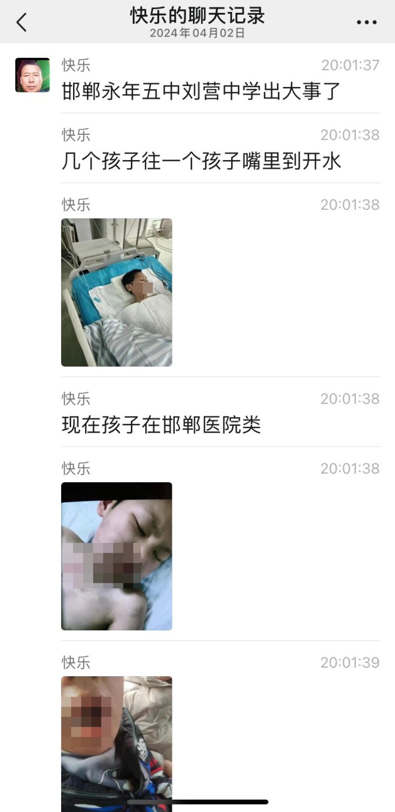 邯郸初中生被人灌滚水受伤事件曝光